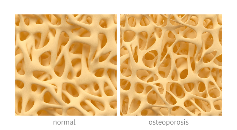 normalios struktūros kaulai ir kaulai, sergantys osteoporoze.